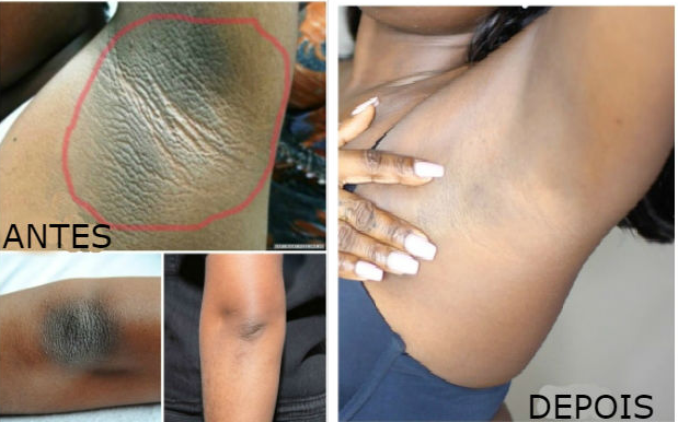 CleanSkin™ 3D - Clareador de Manchas 6 Em 1